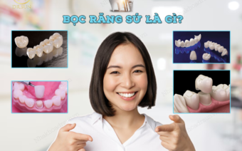 Bọc răng sứ là gì? có nên bọc răng sứ không? Chi phí