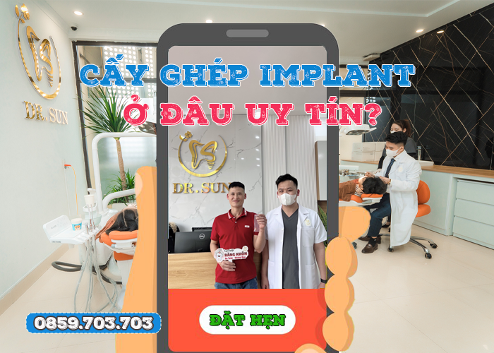 cay-ghep-implant-o-dau-uy-tin