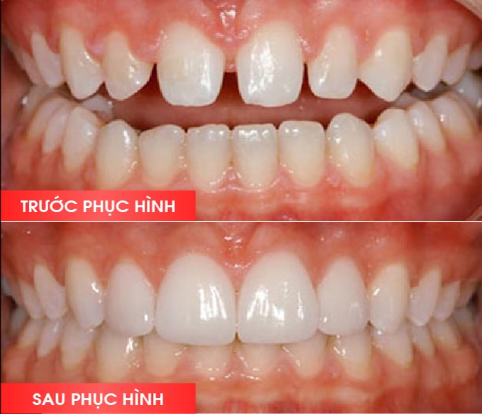 ảnh thực tế sau khi dán mặt sứ Veneer