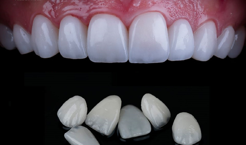khi nào nên dán sứ Veneer