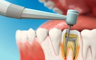 Điều trị tủy răng: Cách bảo tồn răng thật hiệu quả