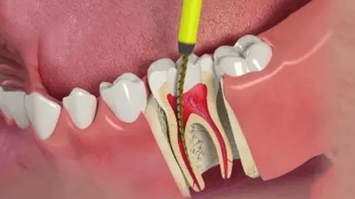 Điểu trị tủy răng