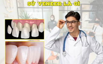 Dán sứ Veneer là gì? chi phí thực hiện bao nhiêu tiền