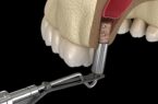 Nâng xoang kín trong cắm Implant