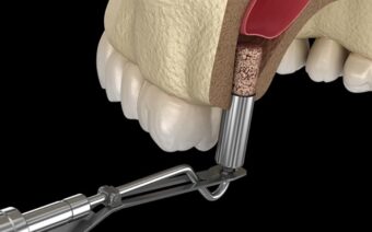 Nâng Xoang Kín Trong Cấy Ghép Implant những điều cần biết
