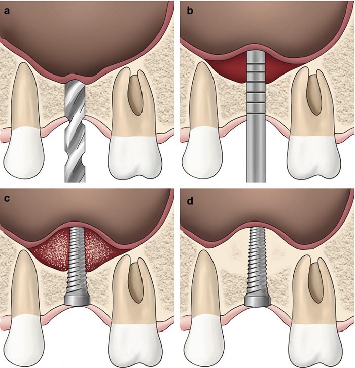 Nâng xoang kín khi cắm implant