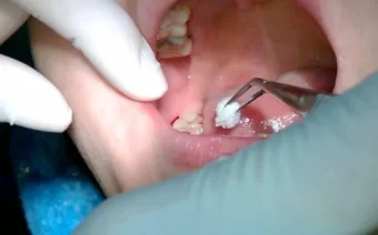 Nhổ răng khôn: Quy trình thực hiện, những lưu ý cần biết