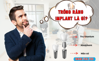 Tổng quan về Trồng răng implant