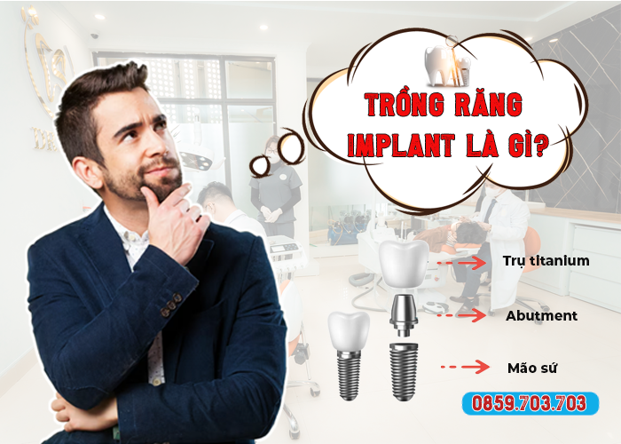 trong rang implant la gi