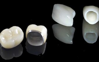 Răng sứ Titan là gì? Ưu và nhược điểm của răng sứ Titan