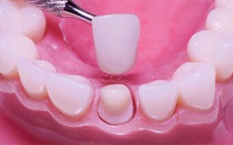 Bọc răng sứ có đau không? Có cần gây tê không