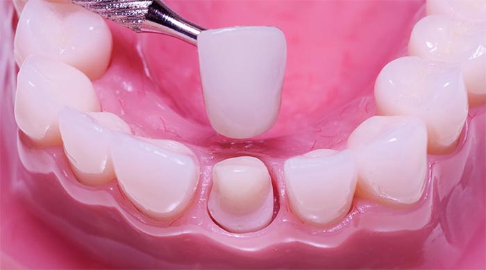 Bọc răng sứ có chảy máu không