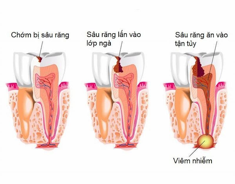 Sâu răng ăn vào tủy gây viêm nếu không điều trị