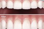 Cắt lợi thẩm mỹ