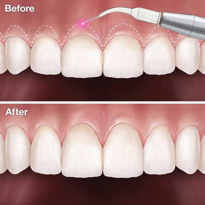 Cắt lợi thẩm mỹ