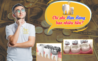 Chi phí hàn răng bao nhiêu tiền