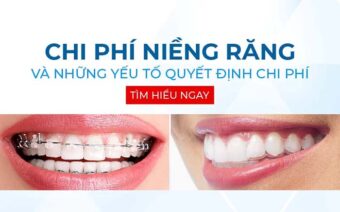 Tổng chi phí niềng răng bao nhiêu tiền? Bảng giá 2024