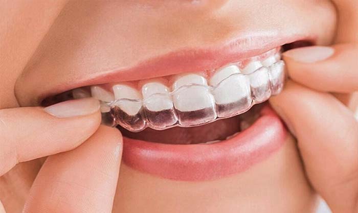 Niềng răng hô với hàm trong suốt Invisalign