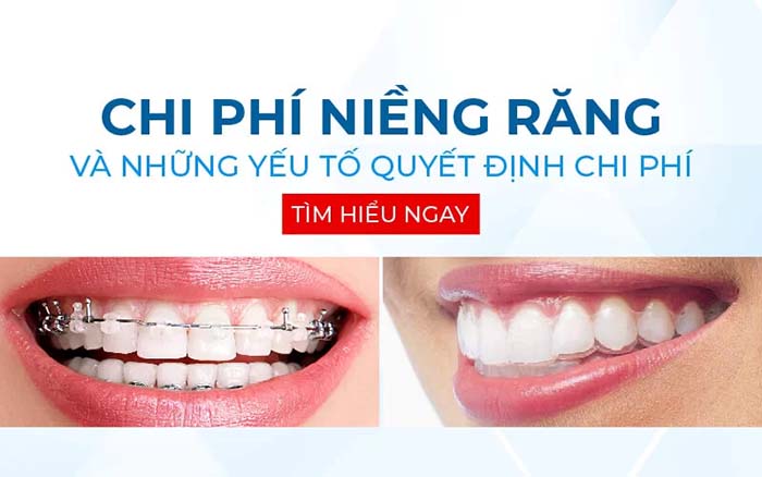 chi phí niềng răng bao nhiêu tiền
