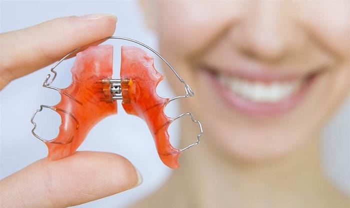 Hàm duy trì sau khi tháo niềng