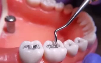 Trám răng là gì? khi nào nên trám răng, quy trình thực hiện