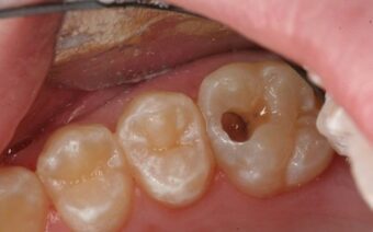 Nguyên nhân gây ra hôi miệng và biện pháp xử lý dứt điểm