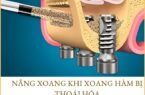Nâng xoang hở