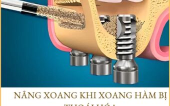 Kỹ Thuật Nâng Xoang Hở Trong Cấy Ghép Implant