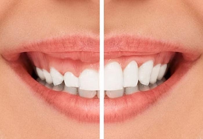 Những trường hợp nên cắt lợi