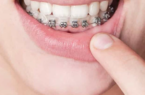 Niềng răng hàm dưới