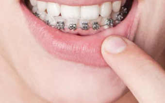 Giá niềng răng 1 hàm tại Thái Nguyên bao nhiêu tiền