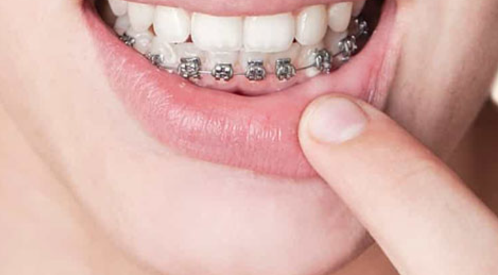 Niềng răng hàm dưới