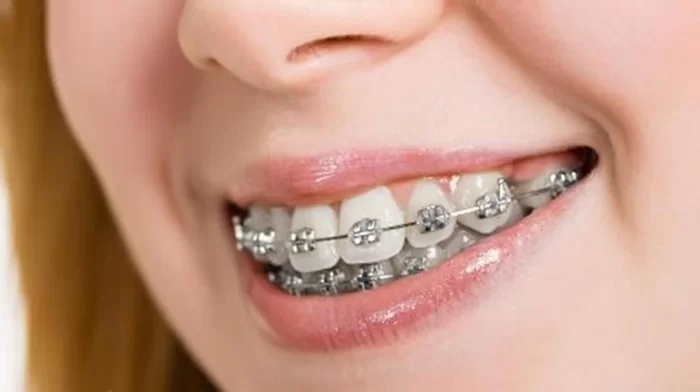 răng bị hô nhẹ cả 2 hàm