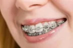 Niềng răng hô có cần nhổ răng không