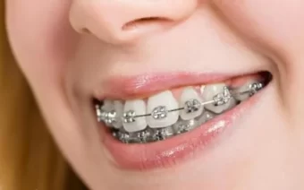 Niềng răng hô và những điều cần biết