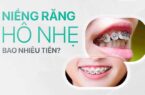 Niềng răng hô nhẹ bao nhiêu tiền
