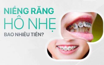 Chi phí niềng răng hô nhẹ bao nhiêu tiền