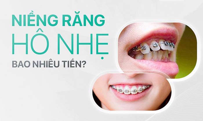 Niềng răng hô nhẹ bao nhiêu tiền