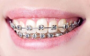 Niềng răng mắc cài là gì? Ưu và nhược điểm