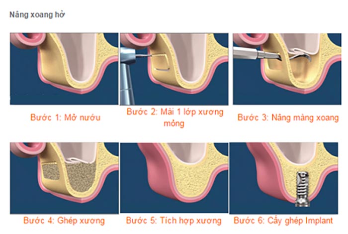 quy trình nâng xoang hở