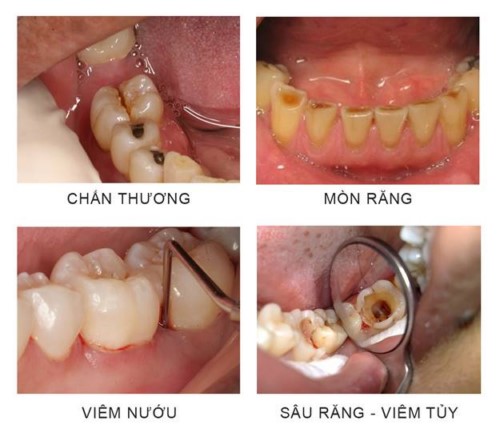 nguyên nhân gây ê buốt răng