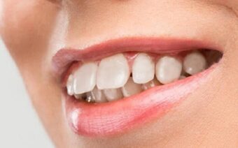 Răng hô, vẩu: Cách khắc phục hiệu quả