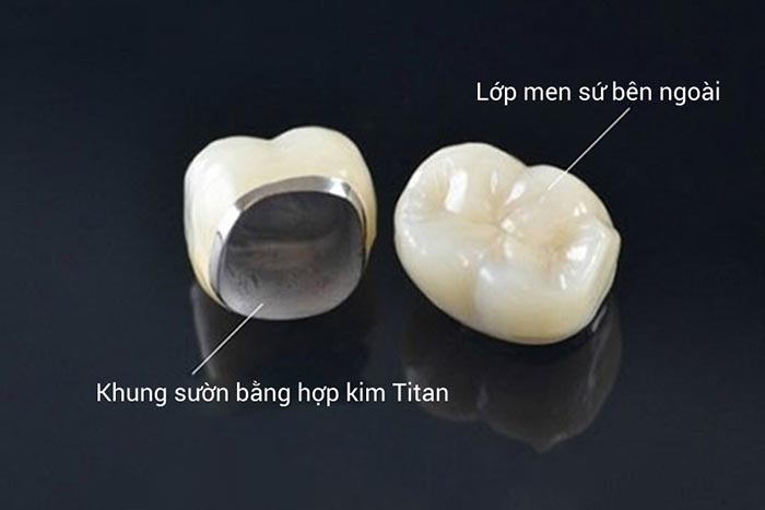 Răng sứ titan