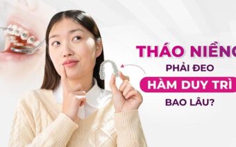 Hàm duy trì là gì? Vì sao nên đeo hàm duy trì sau niềng răng?