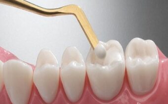 Hàn răng sâu: Những điều cần lưu ý khi thực hiện