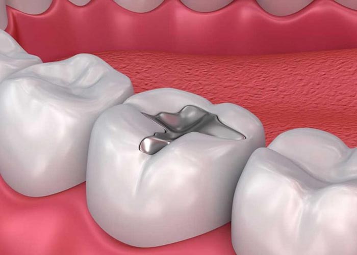 Trám răng bằng Amalgam