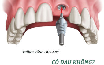 Trồng răng implant có đau không? Bao lâu thì phục hồi