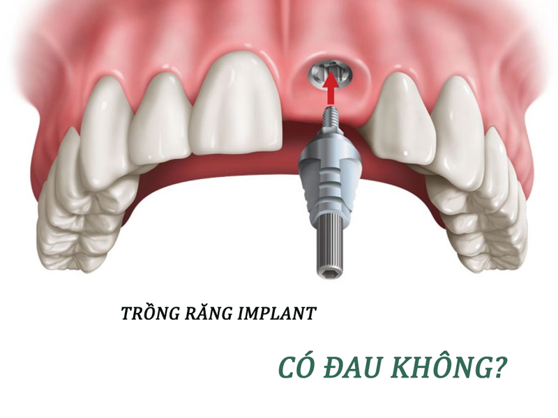 Trồng implant có đau không