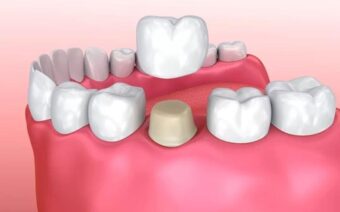 Trồng răng sứ cố định là gì? Chi phí thực hiện bao nhiêu?