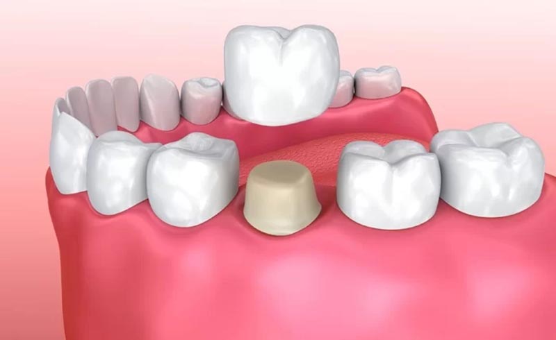 Trồng răng cố định